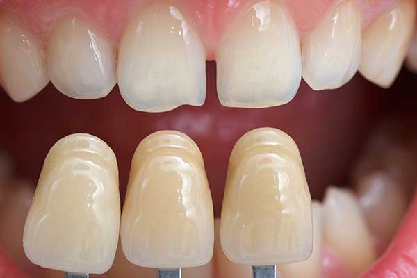Tooth shade guide being held up to teeth